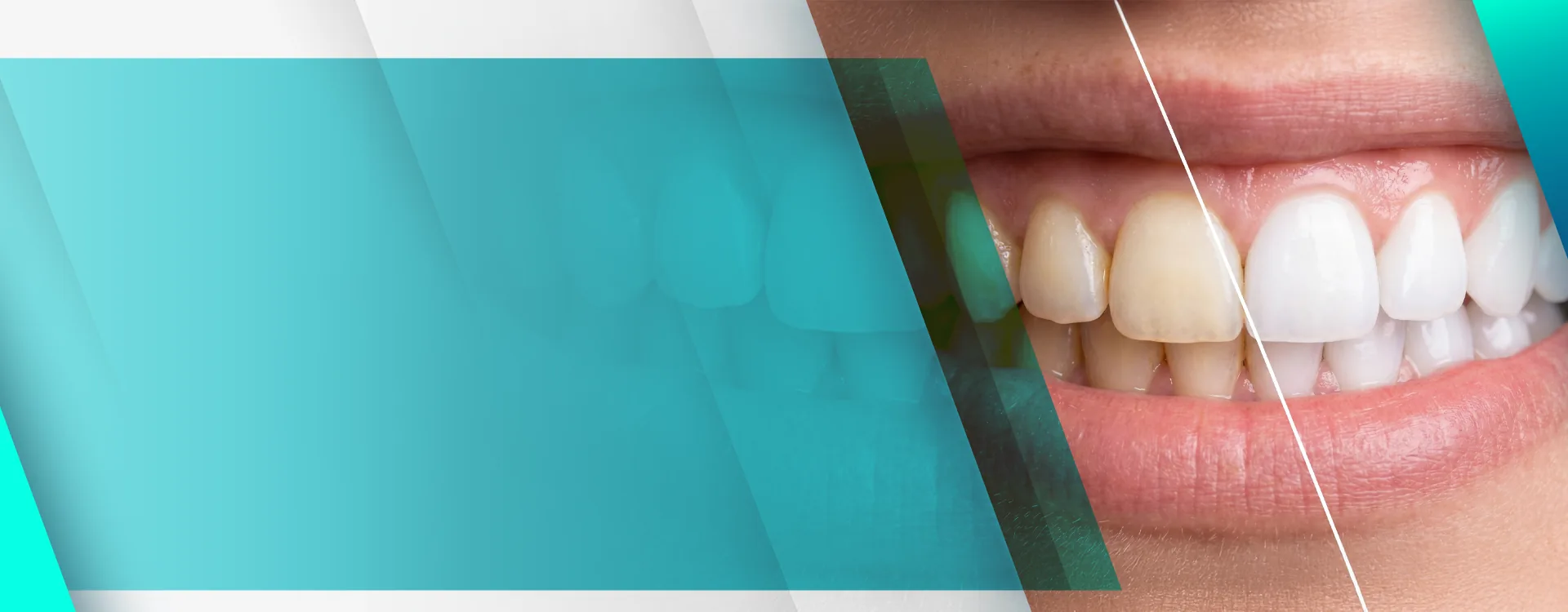 Facetas e clareamento dental