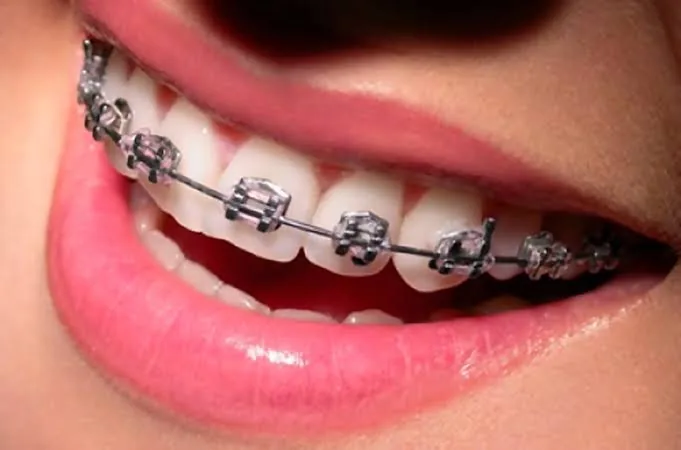 Ortodontia e Implantes