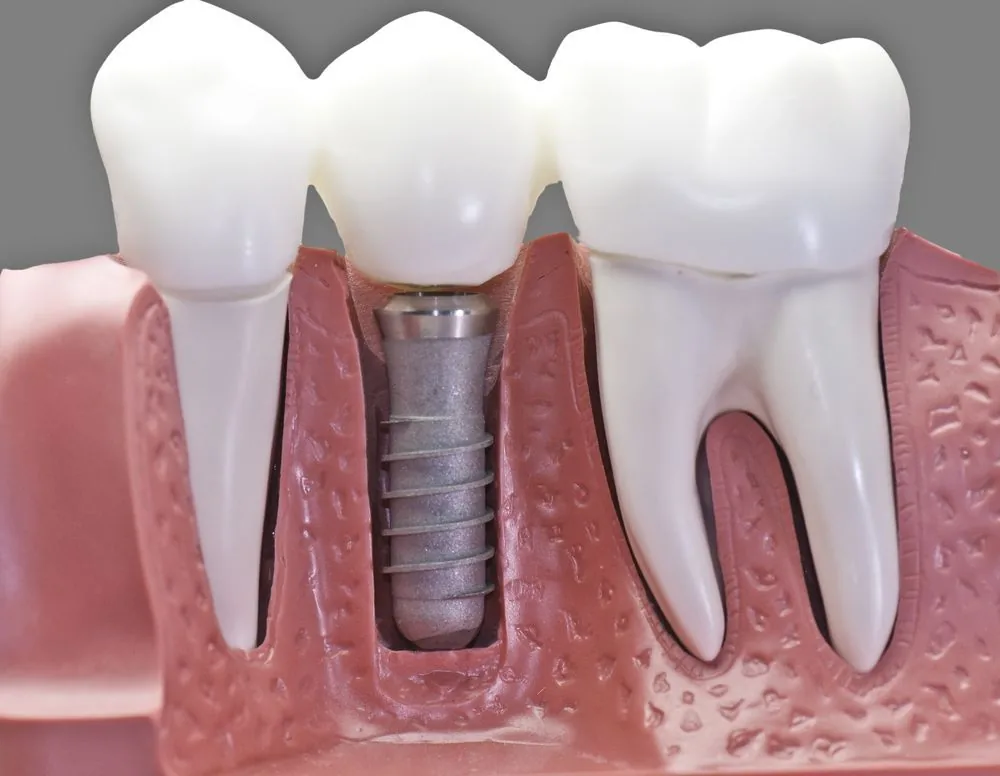 Coroas Dentárias: Proteção e Estética Para Seus Dentes
