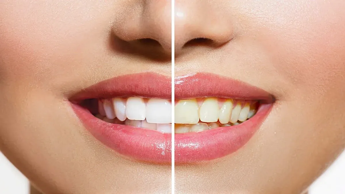 Clareamento dentário